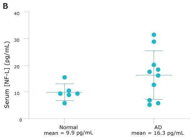 NF-L serum concentrations of AD (n=10) show nearly double that of normal (n=6) samples.