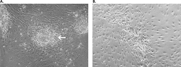 Primary culture derived from an invasive adenocarcinoma with the Primary Cancer Culture System