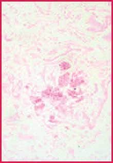 Positive fungus control. Chromic acid-Schiff stain, 400X