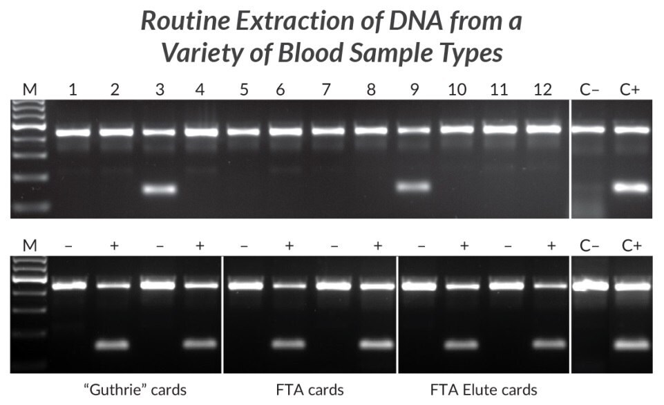 Extraction and amplification of DNA from different blood sample types for detection of the HLA-B*27 allele.