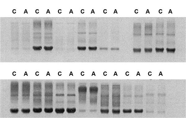 Results of electrophoretic resolution of free immunoglobulin light chains